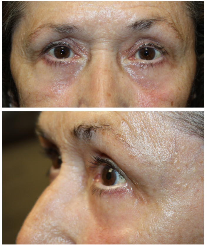 Upper and Lower Blepharoplasty with TCA Peel After