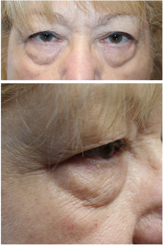 Upper and Lower Blepharoplasty, Internal Ptosis Repair, and TCA Peel Before