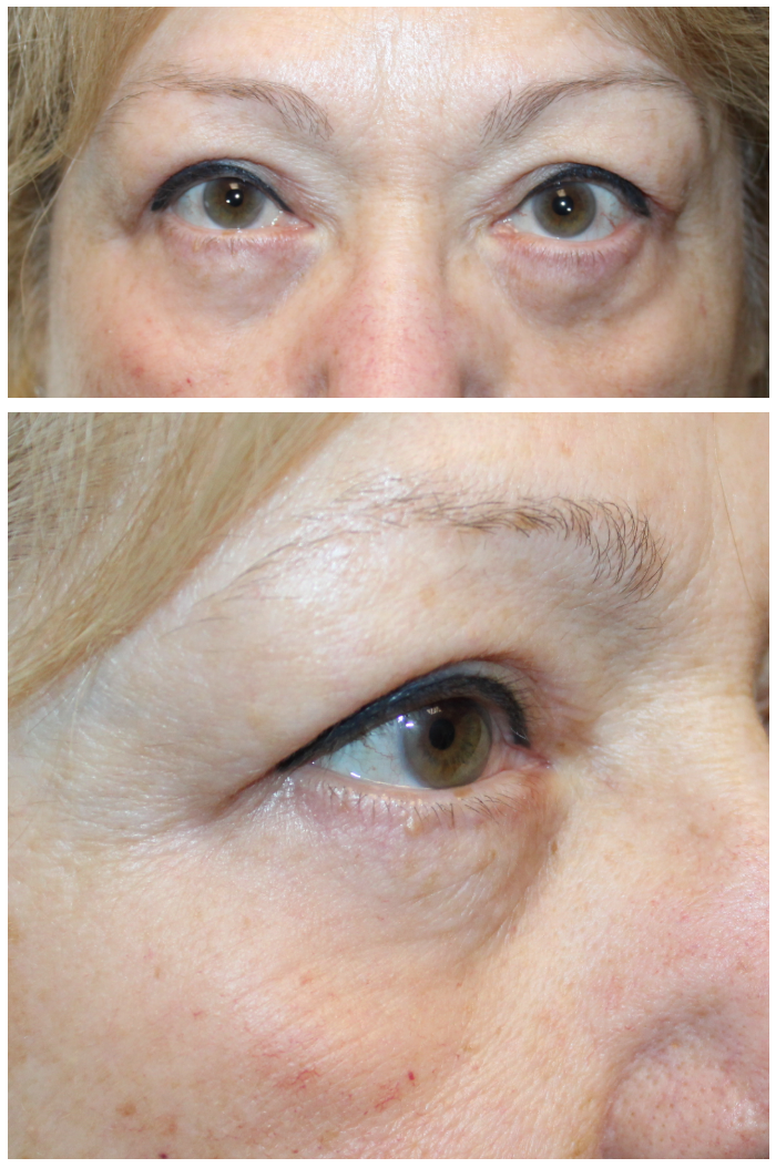 Upper and Lower Blepharoplasty, Internal Ptosis Repair, and TCA Peel After