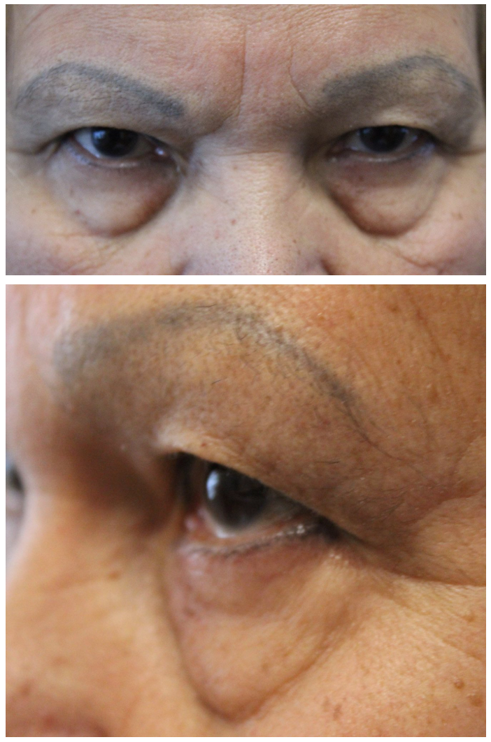 Upper and Lower Blepharoplasty Before