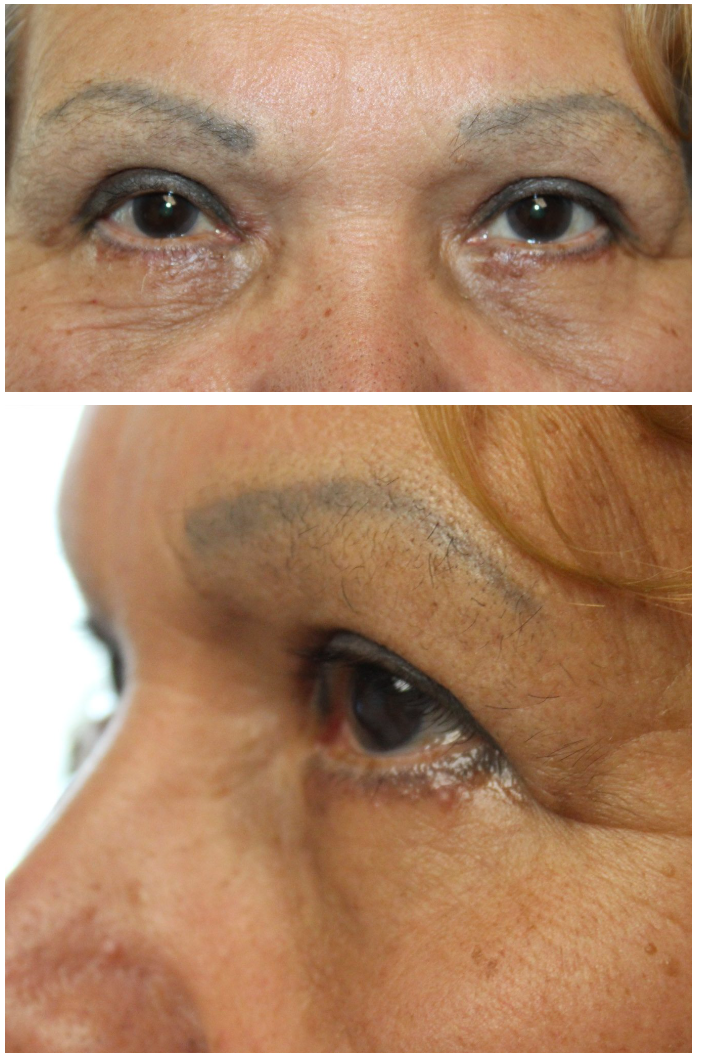 Upper and Lower Blepharoplasty After
