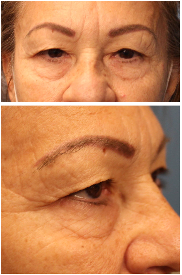 Upper & Lower Blepharoplasty with TCA peel Before