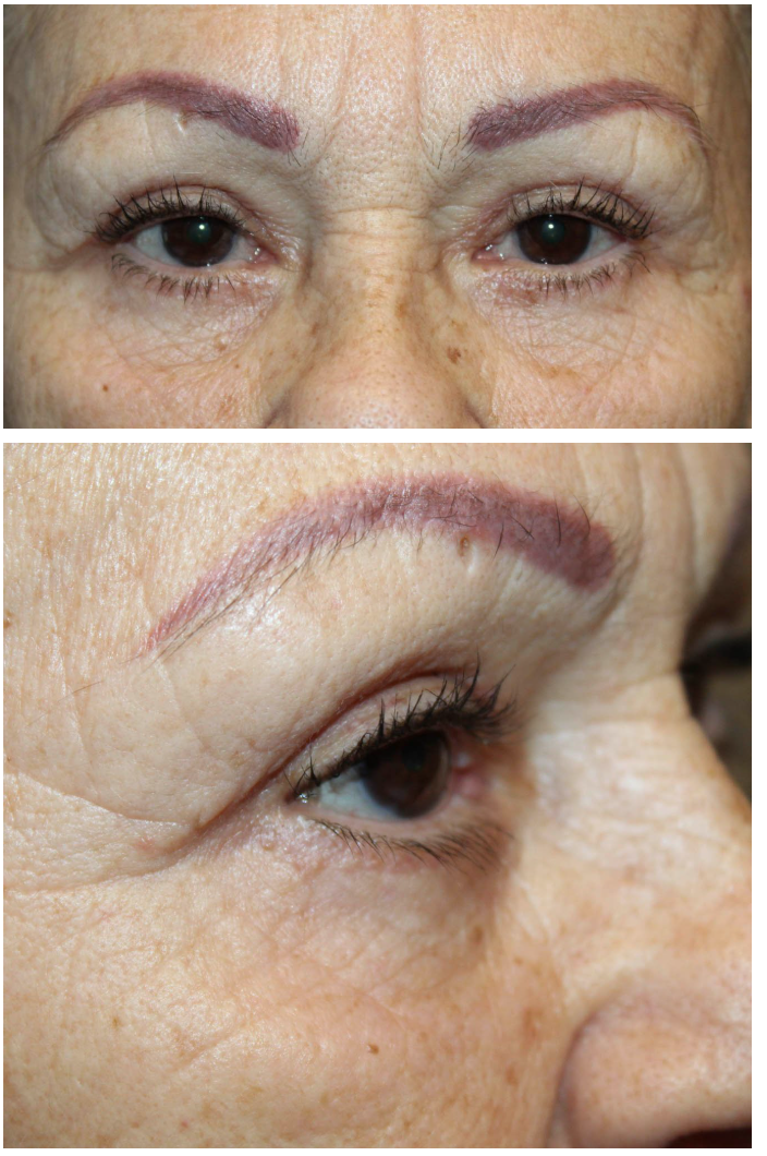 Upper & Lower Blepharoplasty with TCA peel After
