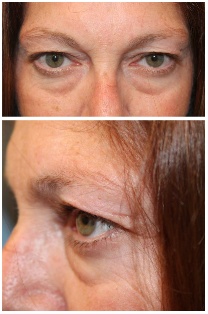Upper & Lower Blepharoplasty Before
