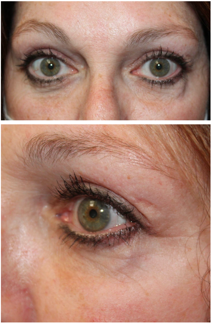 Upper & Lower Blepharoplasty After
