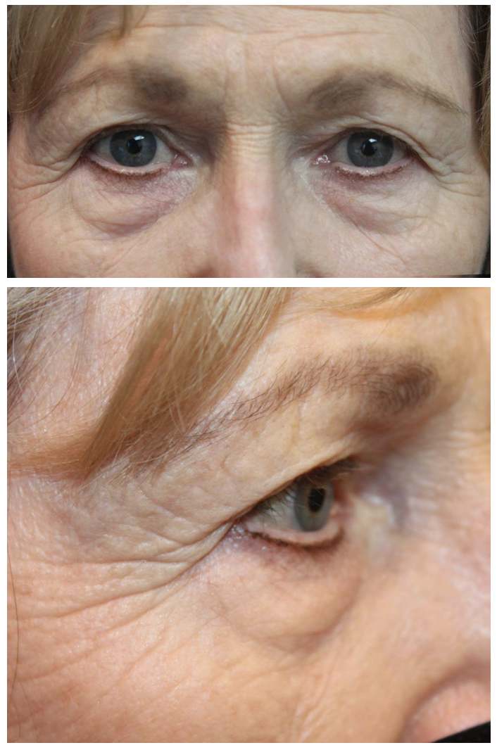 Upper & Lower Blepharoplasty with TCA peel and Brow Ptosis Repair Before