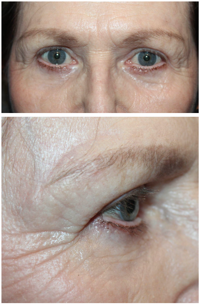 Upper & Lower Blepharoplasty with TCA peel and Brow Ptosis Repair After