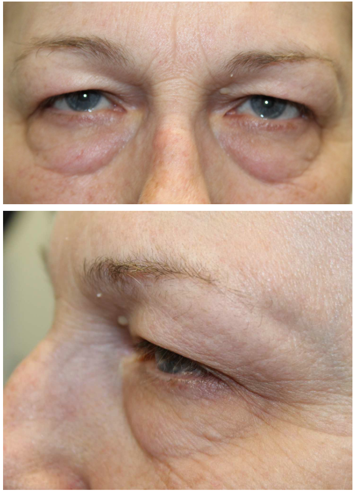 Upper & Lower Blepharoplasty Before