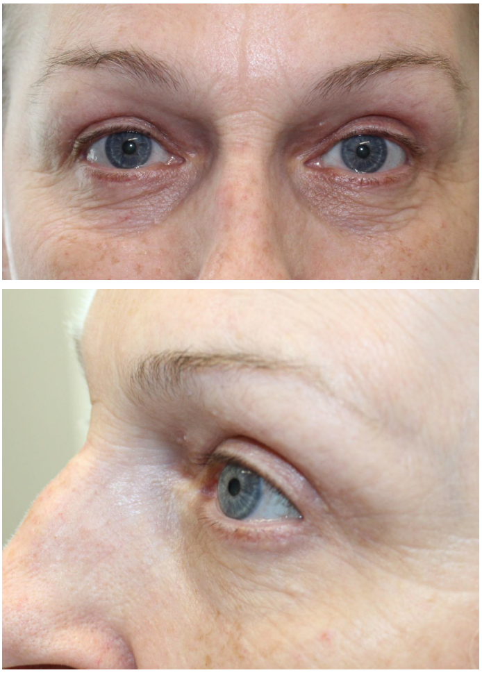 Upper & Lower Blepharoplasty After