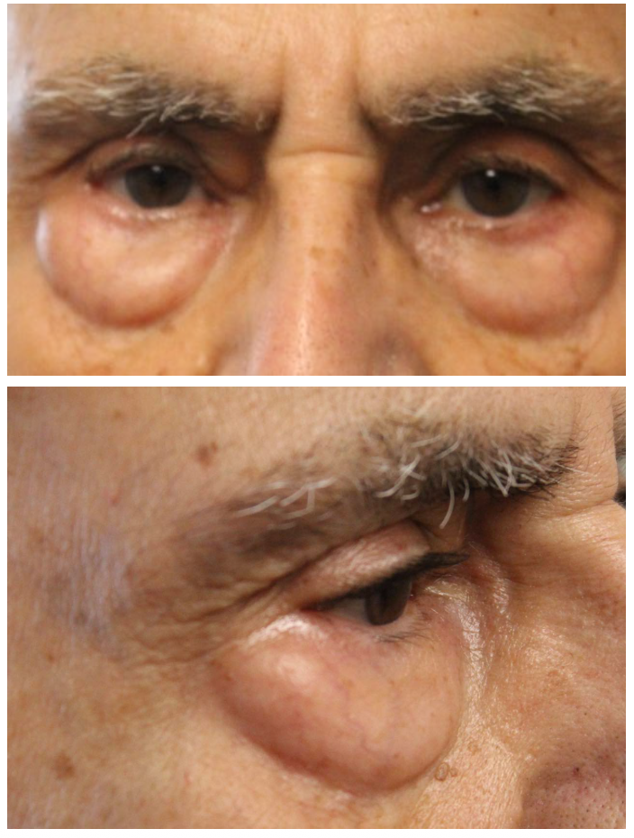 Lower Blepharoplasty Before
