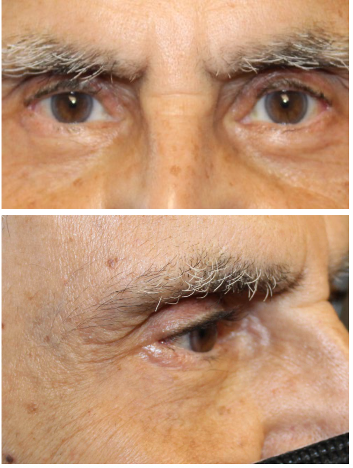 Lower Blepharoplasty After