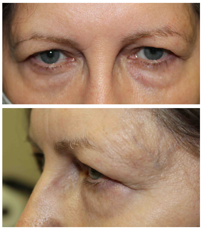 Upper & Lower Blepharoplasty Before