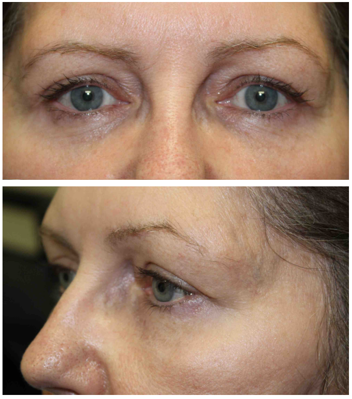 Upper & Lower Blepharoplasty After