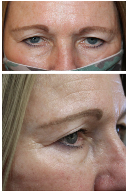 Upper Blepharoplasty and Brow Ptosis Repair Before