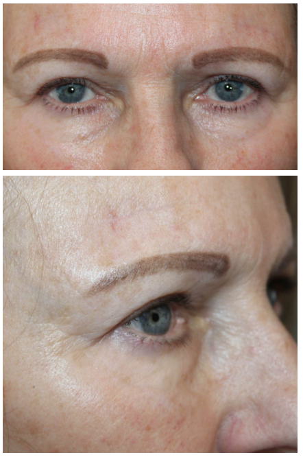 Upper Blepharoplasty and Brow Ptosis Repair After
