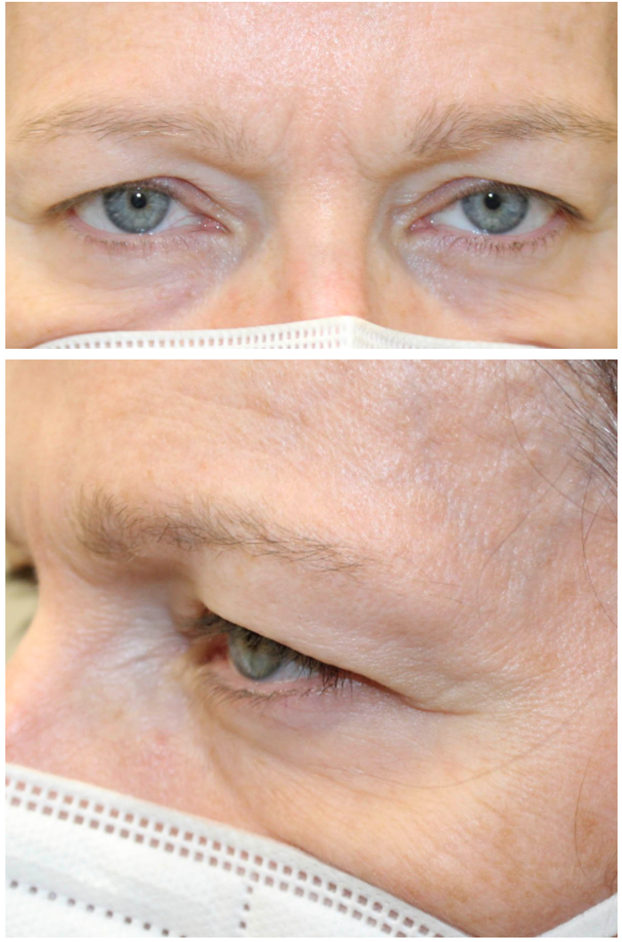 Upper Blepharoplasty Before
