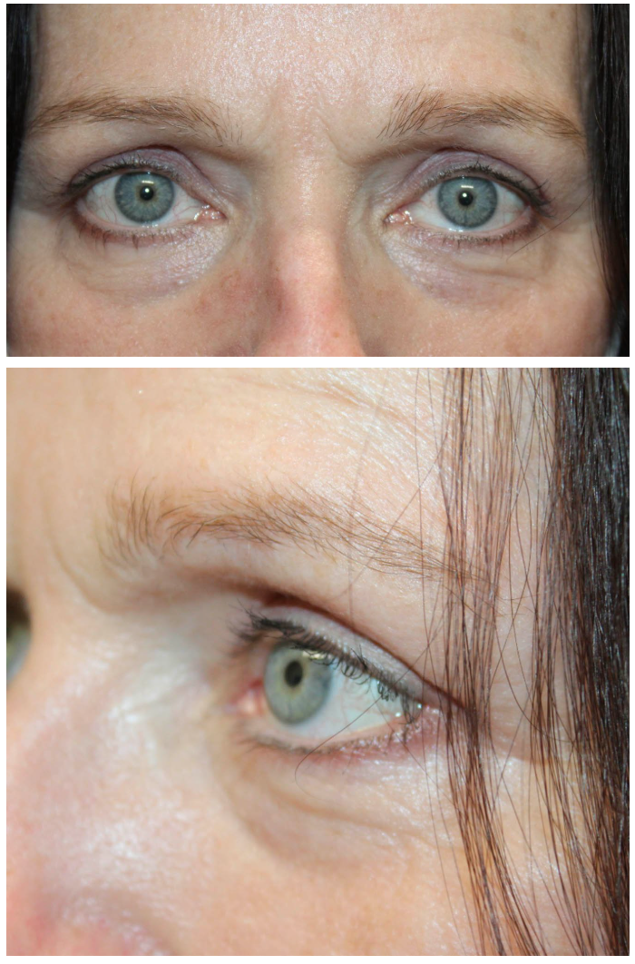 Upper Blepharoplasty After