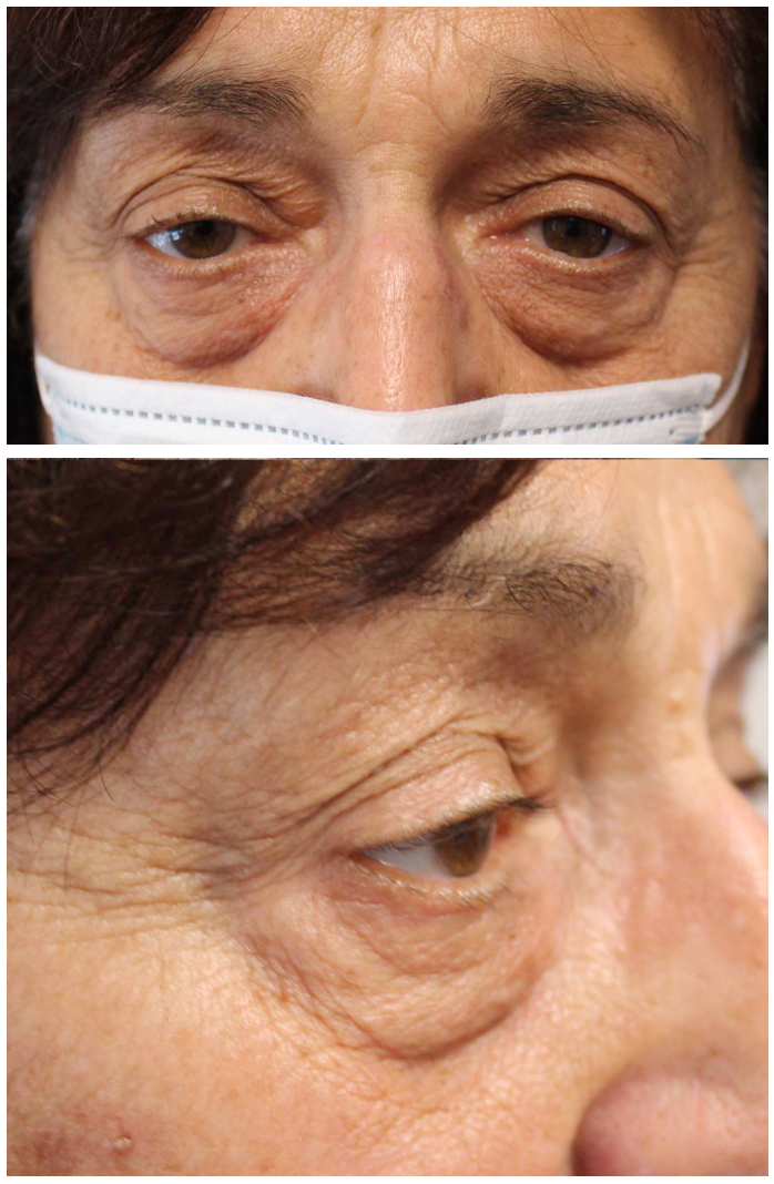 Upper & Lower Blepharoplasty with Upper Eyelid Ptosis Repair Before