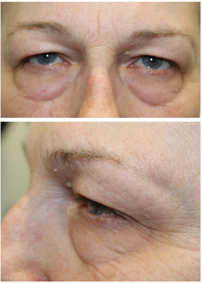 Upper & Lower Blepharoplasty Before