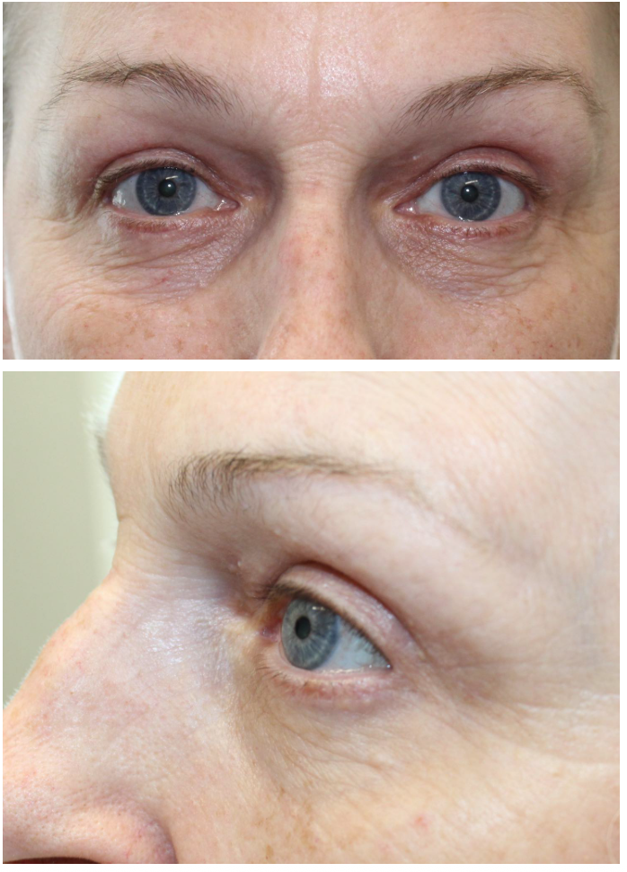 Upper & Lower Blepharoplasty After