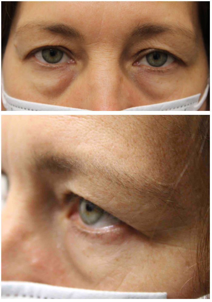 Upper & Lower Blepharoplasty Before
