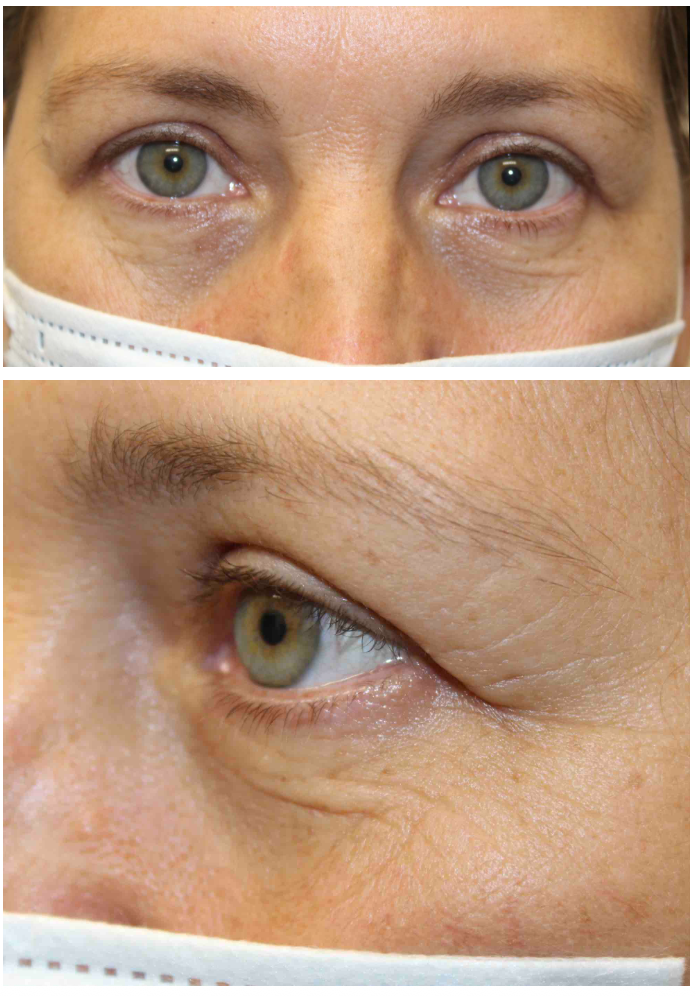 Upper & Lower Blepharoplasty After