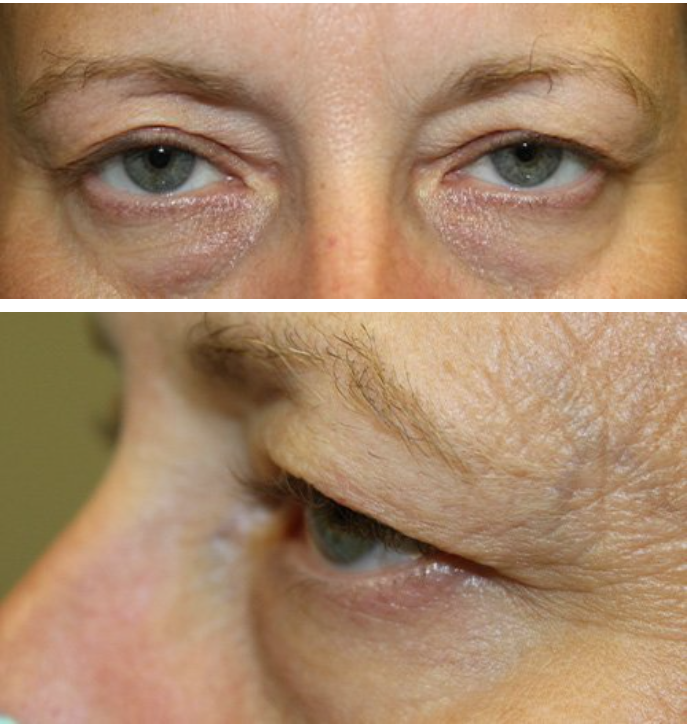 Upper & Lower Eyelid Blepharoplasty Before