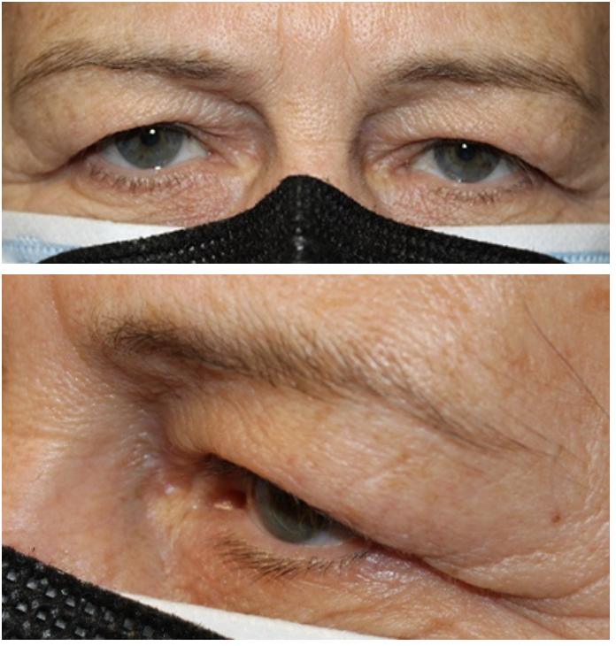 Bilateral Upper Blepharoplasty with Temporal Brow Lift Before