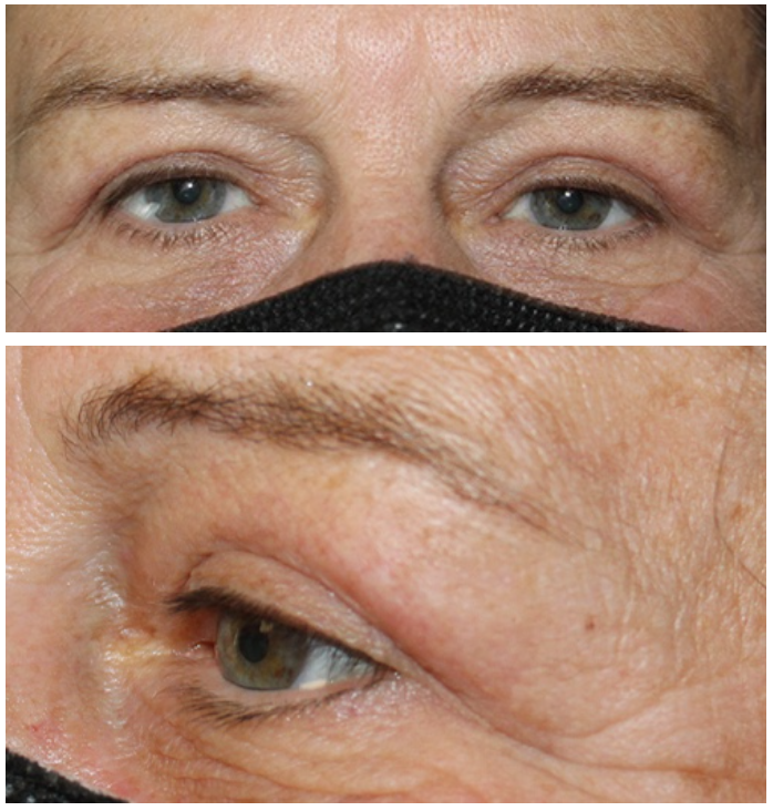 Bilateral Upper Blepharoplasty with Temporal Brow Lift After