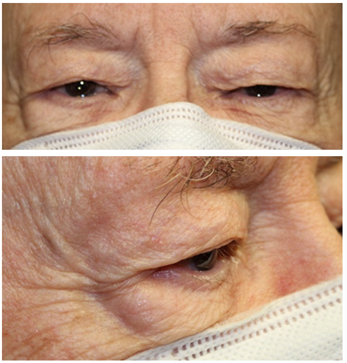 Bilateral Upper Blepharoplasty Before