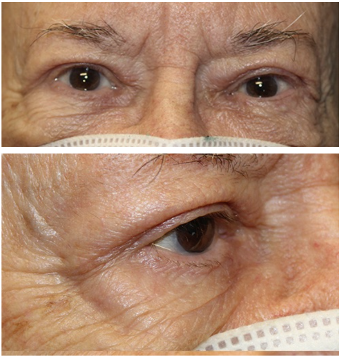 Bilateral Upper Blepharoplasty After