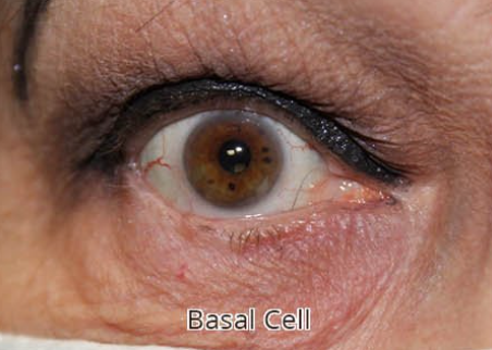 Repair of 60% Defect of Eyelid from Basal Cell Carcinoma with a Hughes flap