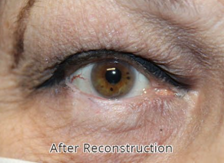 Repair of 60% Defect of Eyelid from Basal Cell Carcinoma with a Hughes flap