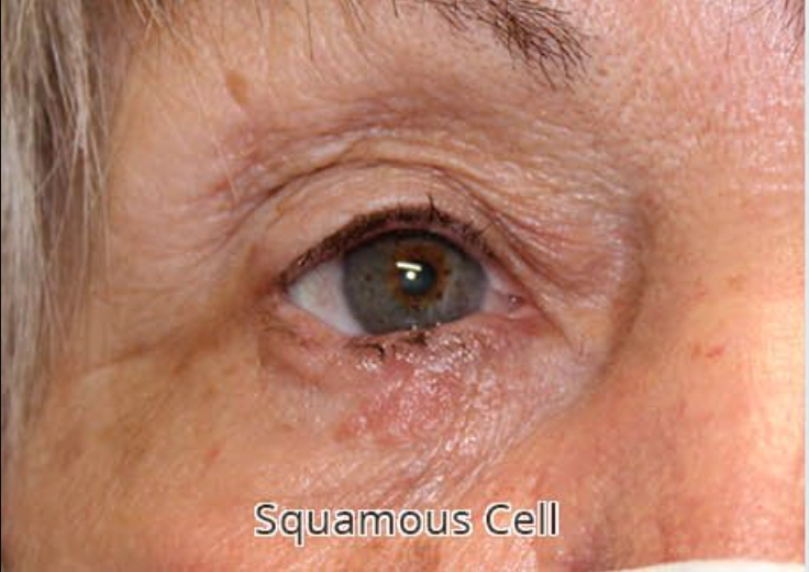 Removal of Squamous Cell Carcinoma