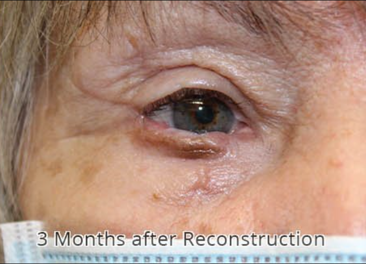 Removal of Squamous Cell Carcinoma