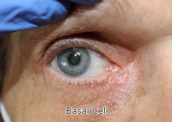 Eyelid & Tear Duct Reconstruction