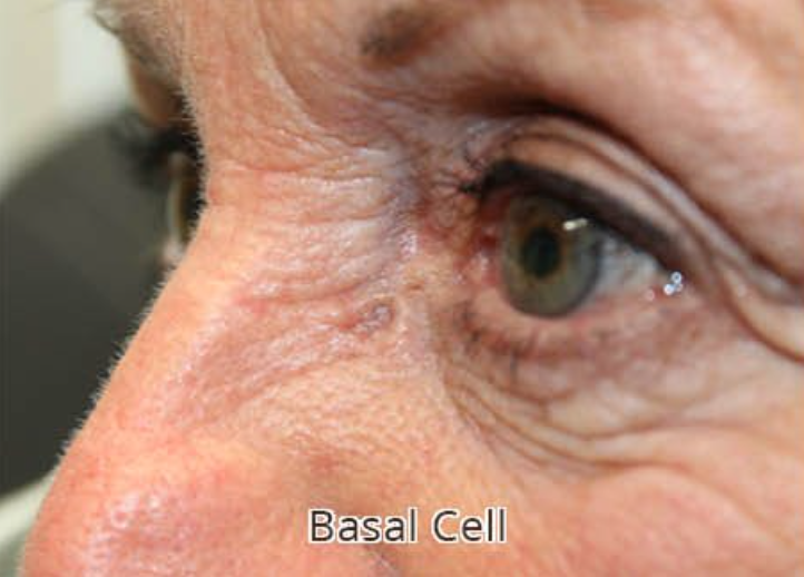 Eyelid Reconstruction