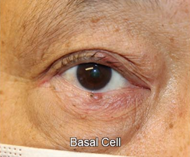 Eyelid Reconstruction
