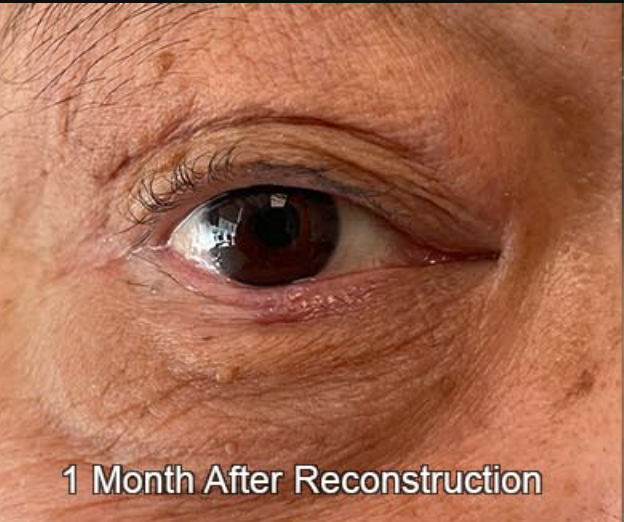 Eyelid Reconstruction