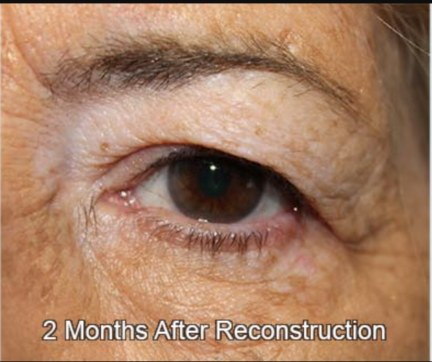 Eyelid Reconstruction