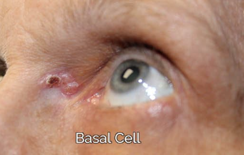 Eyelid Reconstruction After Skin Cancer