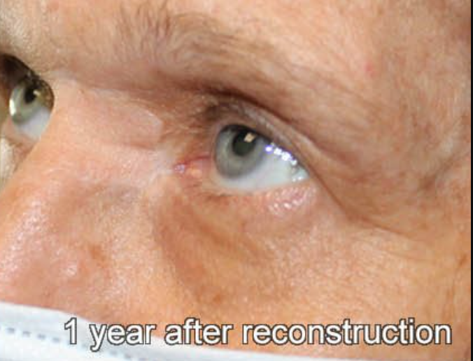 Eyelid Reconstruction After Skin Cancer