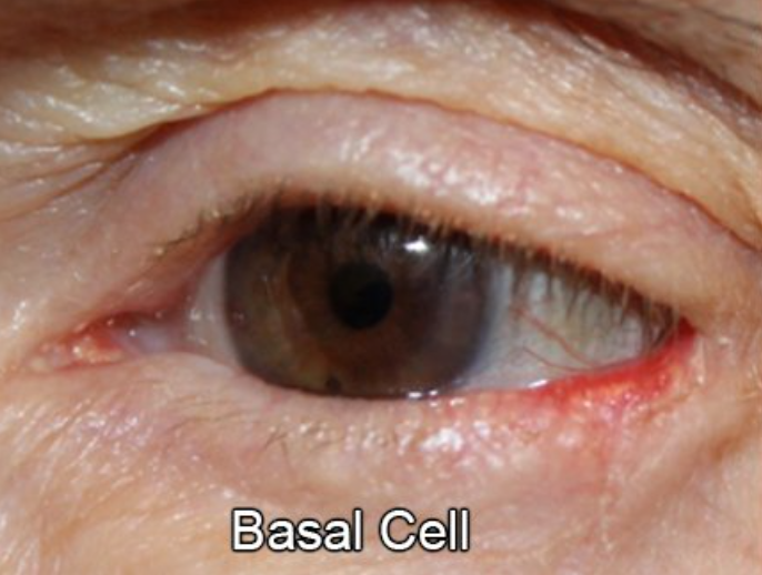 Eyelid Reconstruction After Skin Cancer