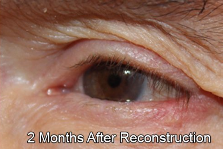 Eyelid Reconstruction After Skin Cancer