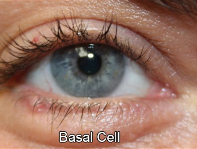 Eyelid Reconstruction After Skin Cancer