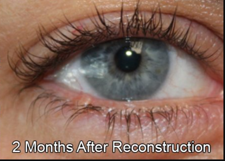 Eyelid Reconstruction After Skin Cancer