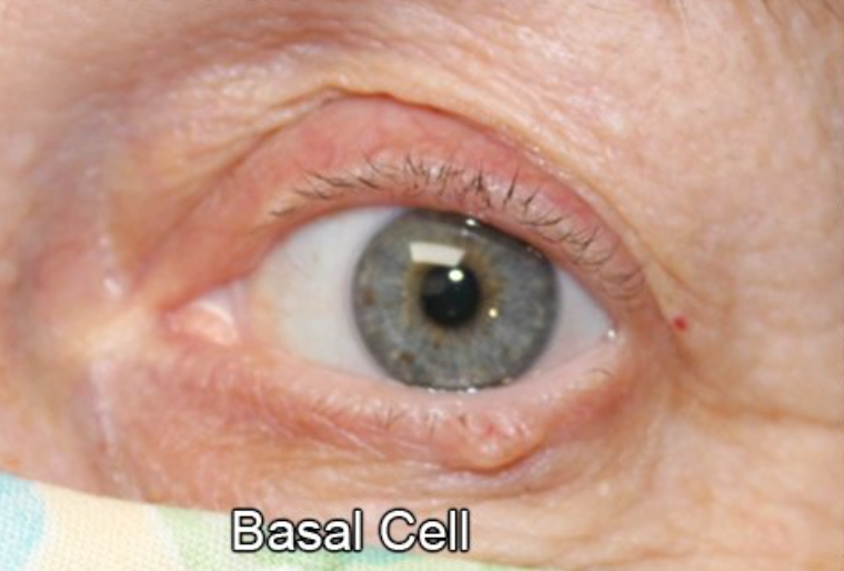 Eyelid Reconstruction After Skin Cancer