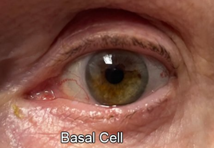 Eyelid Reconstruction After Skin Cancer