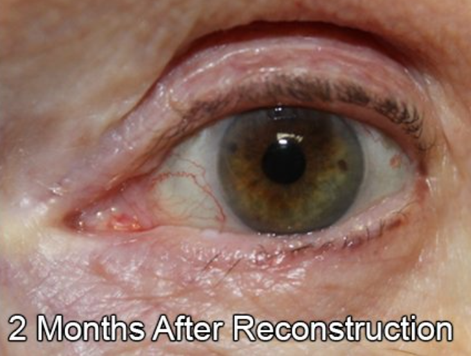 Eyelid Reconstruction After Skin Cancer