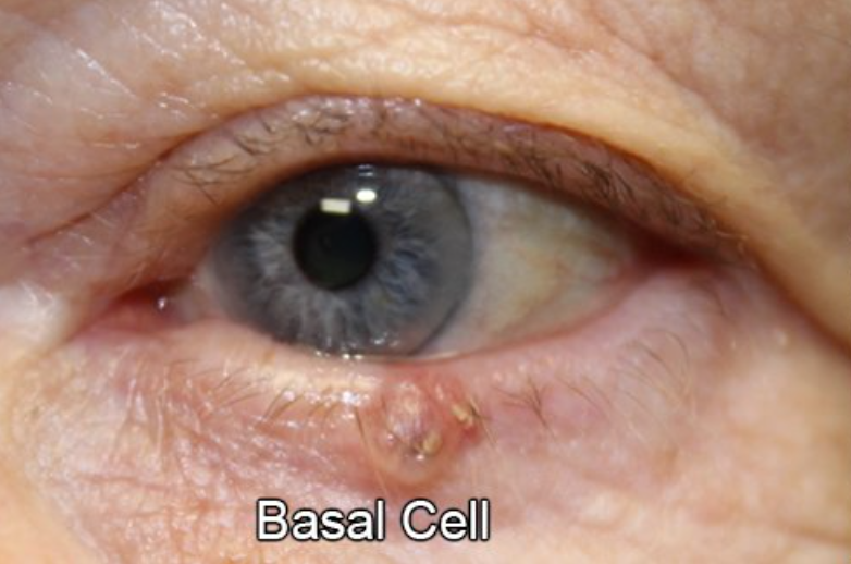 Eyelid Reconstruction After Skin Cancer